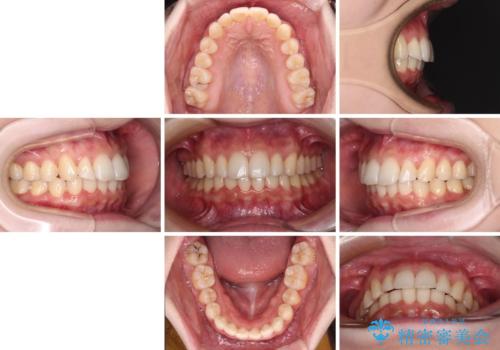 インビザラインを断念 ワイヤー装置で楽々と矯正治療の治療後