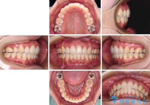 再矯正で突出した口元を引っ込める 抜歯矯正の後戻りの治療後