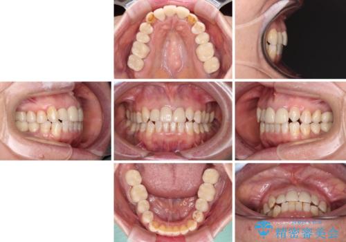 奥歯の銀歯と歯並びを改善　歯周外科治療と矯正治療を行った総合歯科診療の治療後