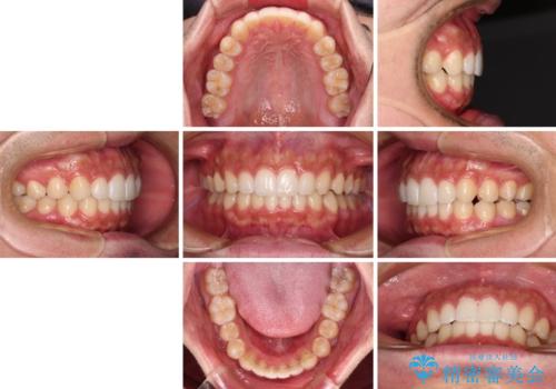 前歯のデコボコと突出感 インビザラインにて矯正治療の治療後