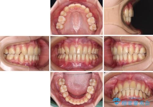 出っ歯を治したい ワイヤー装置による抜歯矯正の治療後