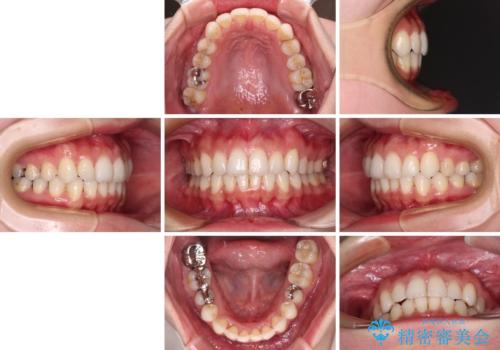 入国制限で帰国できず 海外出張中のインビザライン矯正の治療後