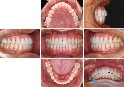 治療途中の前歯を治したい インビザライン矯正とオールセラミッククラウンの治療後