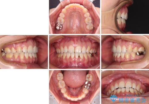 閉じにくい唇を抜歯矯正で閉じやすく 目だたないワイヤー矯正の治療後