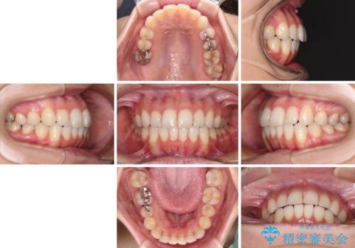 【モニター】前歯のデコボコをインビザラインできれいに整えるの治療後