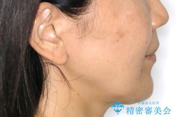 下の前歯が見えない:深い噛み合わせもインビザラインでの治療後(顔貌)
