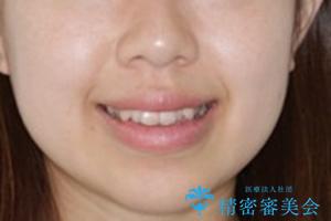 オープンバイト(開咬)を非抜歯インビザラインで治すの治療前(顔貌)