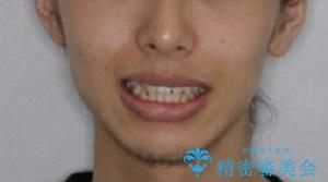 オーディションで歯並びを指摘された:自信をもって歌える口元への治療前(顔貌)