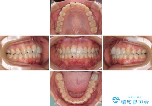前歯のデコボコをインビザラインでスッキリと仕上げるの治療中