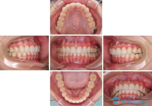 飛び出した前歯と黄ばんだ歯 ホワイトニングしながらマウスピース矯正の治療中