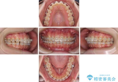 インビザラインを断念 ワイヤー装置で楽々と矯正治療の治療中