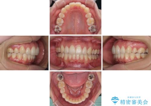 再矯正で突出した口元を引っ込める 抜歯矯正の後戻りの治療中