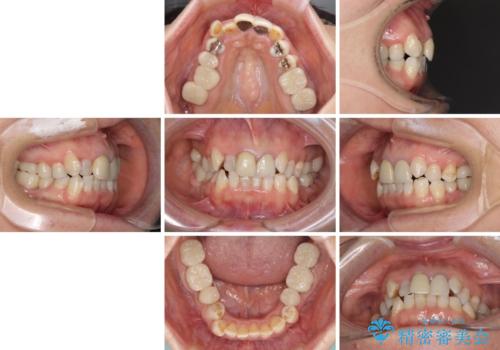 奥歯の銀歯と歯並びを改善　歯周外科治療と矯正治療を行った総合歯科診療の治療中