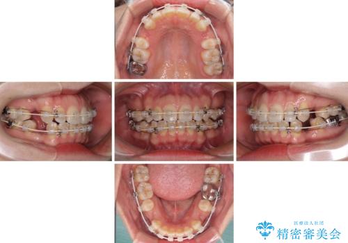 閉じにくい唇を抜歯矯正で閉じやすく 目だたないワイヤー矯正の治療中