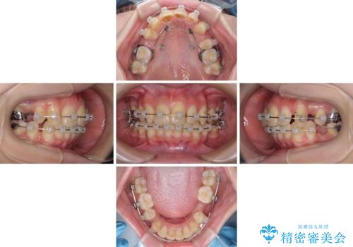 出っ歯を治したい ワイヤー装置による抜歯矯正の治療中