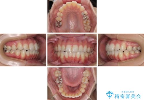 【モニター】前歯のデコボコをインビザラインできれいに整えるの治療中