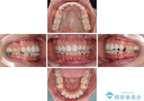 目立たない装置で横顔のシルエットを改善 ハーフリンガルでの抜歯矯正の治療中