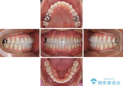 治療途中の前歯を治したい インビザライン矯正とオールセラミッククラウンの治療中