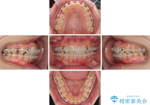 変則的な抜歯矯正 八重歯を抜いてしまった人のワイヤー矯正の治療中