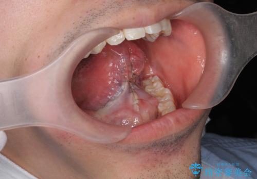 [ 滑舌の改善 ] 即日可能な舌小帯形成の治療後