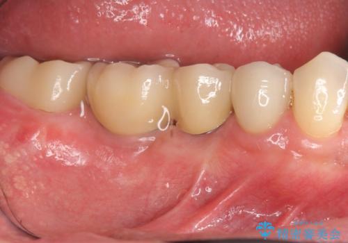 長いブリッジをインプラント補綴への変更の症例 治療後