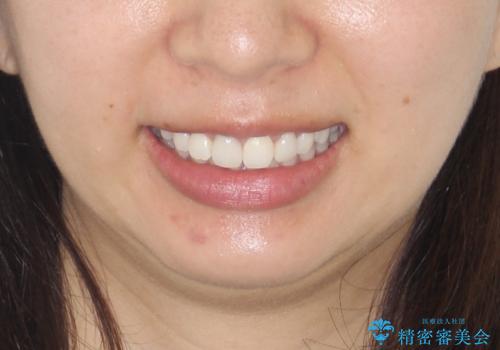 後戻りした歯並びをきれいにしたいの治療後