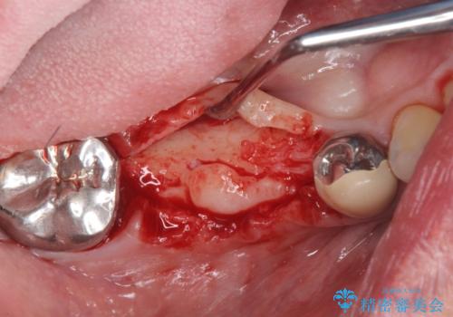 長いブリッジをインプラント補綴への変更の治療中