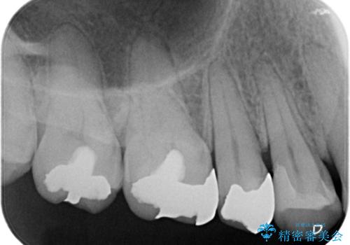 銀歯がとれた!セラミックインレーによる修復の治療後