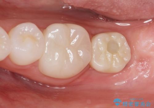 [ インプラント治療 ]  失った歯の咬合機能回復の治療後