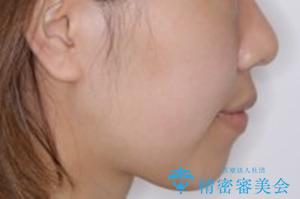 オープンバイト(開咬)を非抜歯インビザラインで治すの治療後(顔貌)