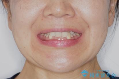 下の前歯が見えない:深い噛み合わせもインビザラインでの治療前(顔貌)