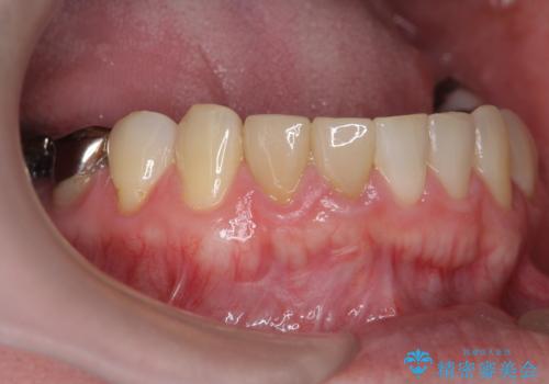 [ 歯ぐきを押すと痛む ]　根管治療の必要な前歯治療の症例 治療後