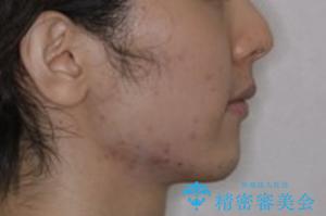 オーディションで歯並びを指摘された:自信をもって歌える口元への治療後(顔貌)