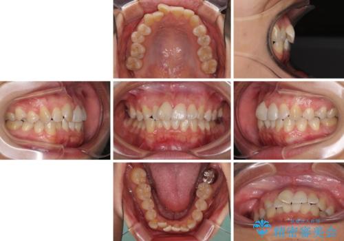 前歯のデコボコをインビザラインでスッキリと仕上げるの治療前