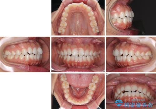 目立たない装置で横顔のシルエットを改善 ハーフリンガルでの抜歯矯正の治療前