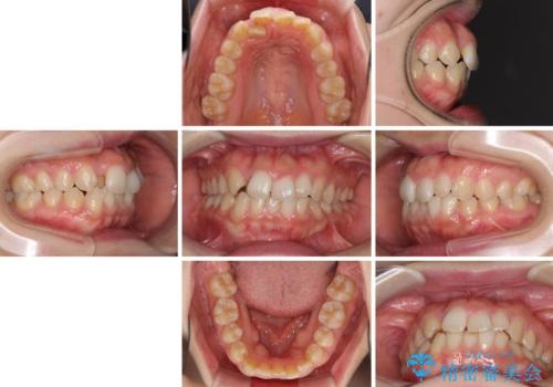変則的な抜歯矯正 八重歯を抜いてしまった人のワイヤー矯正の治療前