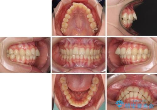 飛び出した前歯と黄ばんだ歯 ホワイトニングしながらマウスピース矯正の治療前