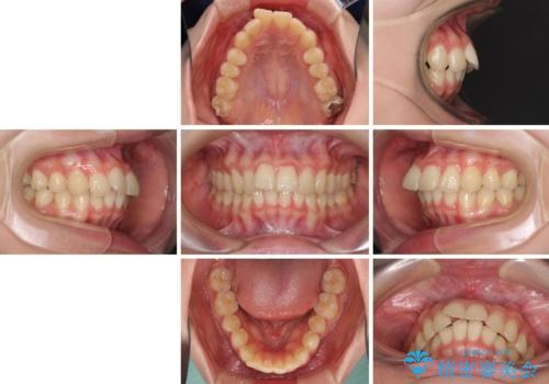 飛び出した前歯と黄ばんだ歯　ホワイトニングしながらマウスピース矯正の治療前