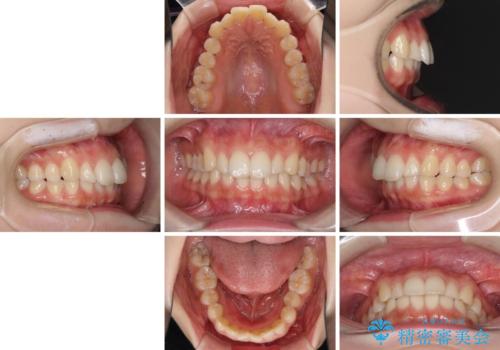 インビザラインを断念 ワイヤー装置で楽々と矯正治療の治療前