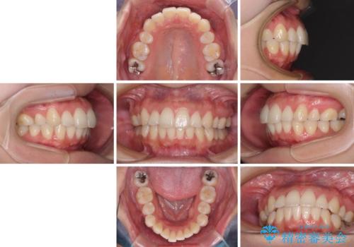 再矯正で突出した口元を引っ込める 抜歯矯正の後戻りの治療前