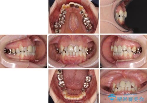 奥歯の銀歯と歯並びを改善　歯周外科治療と矯正治療を行った総合歯科診療の治療前