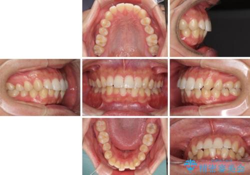 前歯のデコボコと突出感 インビザラインにて矯正治療の治療前