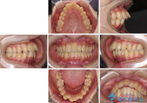 出っ歯を治したい ワイヤー装置による抜歯矯正の治療前