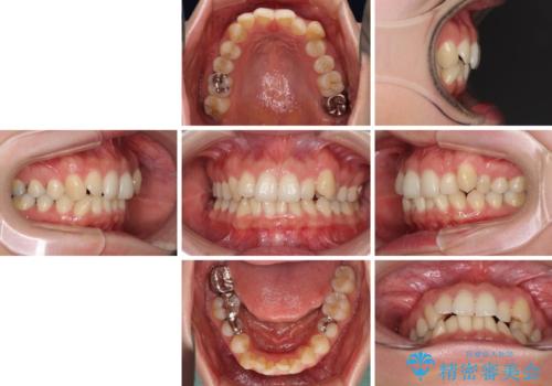 入国制限で帰国できず 海外出張中のインビザライン矯正の治療前