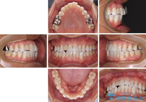 治療途中の前歯を治したい インビザライン矯正とオールセラミッククラウンの治療前