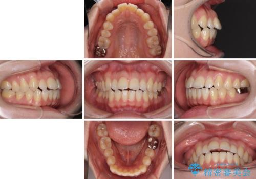 閉じにくい唇を抜歯矯正で閉じやすく 目だたないワイヤー矯正の治療前