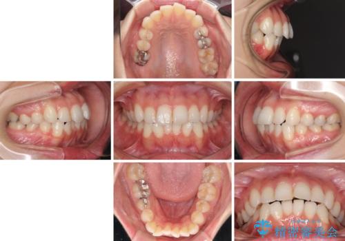 【モニター】前歯のデコボコをインビザラインできれいに整えるの治療前