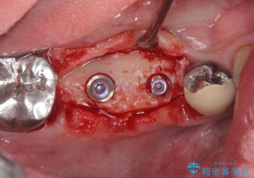 長いブリッジをインプラント補綴への変更の治療中