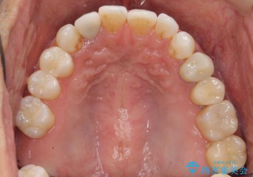 銀歯だらけの口の中を改善したいの症例 治療後