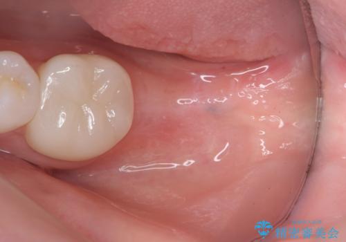 [ インプラント治療 ]  失った歯の咬合機能回復の治療中